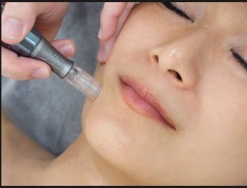 Microneedling